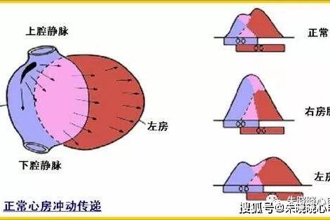 p波异常心电图口诀