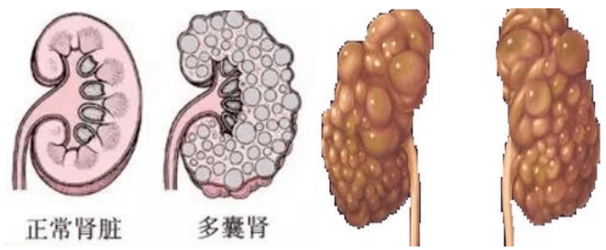 关于多囊肾,你了解多少?