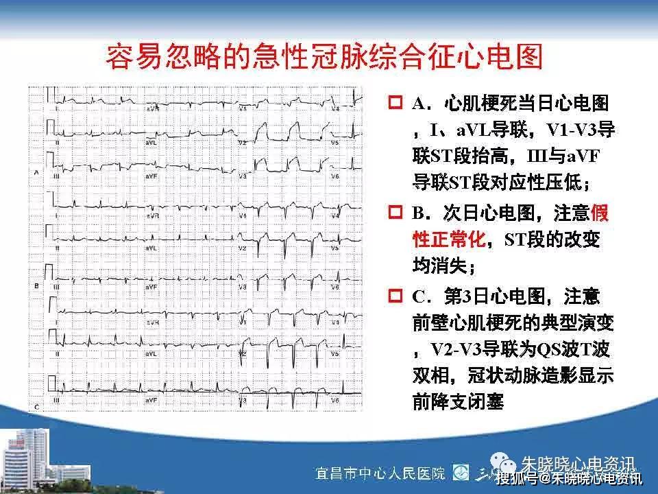 急性冠脉综合征心电图与临床ppt