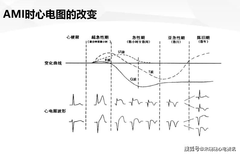 图文详解:急性心肌梗死的判读