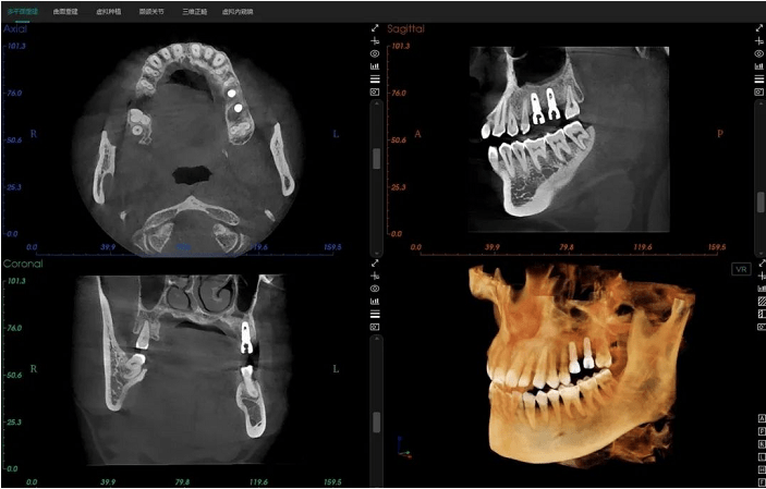 这台有"ai"的口腔cbct来了!