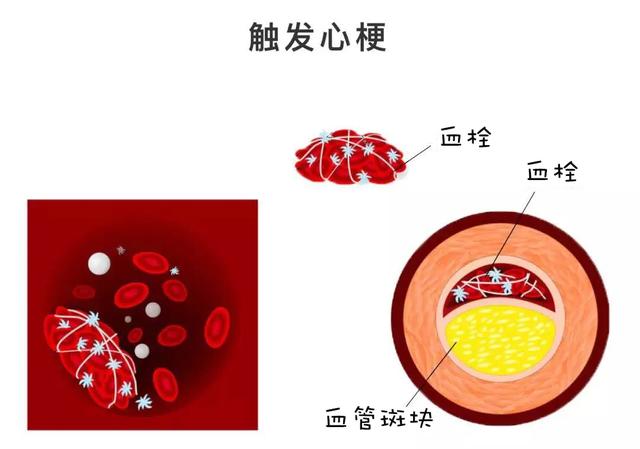 康复心内科专家袁丽霞在线“开药方”预防冠心病