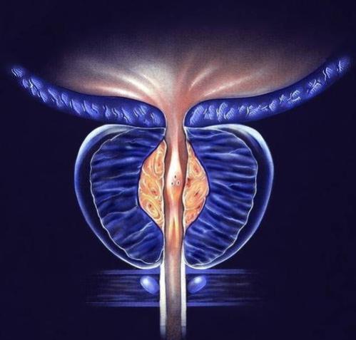 前列腺癌晚期能活多久,前列腺癌该如何进行治疗?