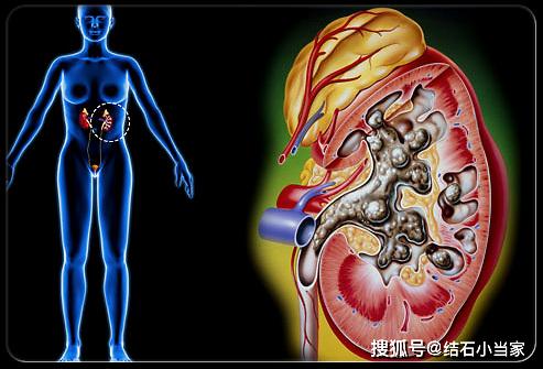 左肾结石怎么检查 96b0e002d26e4033ba4f467865e2ad44.jpeg