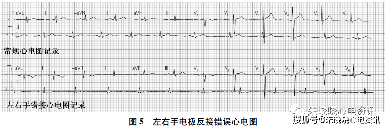 镜像右位心的 f 导联心电图特征读析