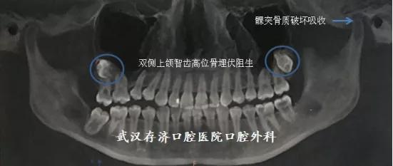 片子显示思涵上颌有两颗高位完全骨埋伏阻生智齿,与上颌窦关系密切