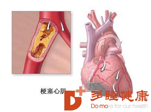 什么原因会引起心肌梗死 009b9094497948738262078c3c38fab7.jpeg