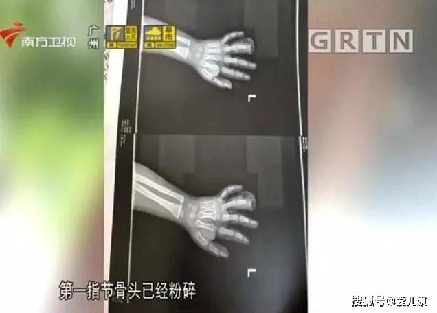 [电梯]男宝手指瞬间粉碎！这件伤娃的东西，很多小区都有…夹一下