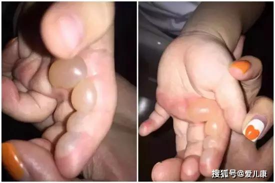 [电梯]男宝手指瞬间粉碎！这件伤娃的东西，很多小区都有…夹一下