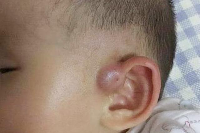 为何有些孩子耳朵上会有“小孔”，医生没有直接讲，家长也要知道