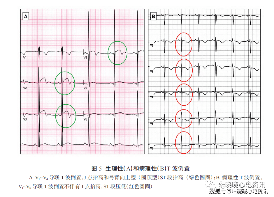 st段抬高或t波双相,更可能仅为运发动心脏,而不伴有j点抬高或同时有st