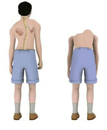 正常人的脊柱从正面看是直的,而脊柱侧弯患者正面看是