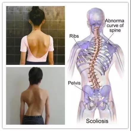 青少年脊柱侧弯是以青少年脊柱持久地偏离身体中线,使脊柱向侧方