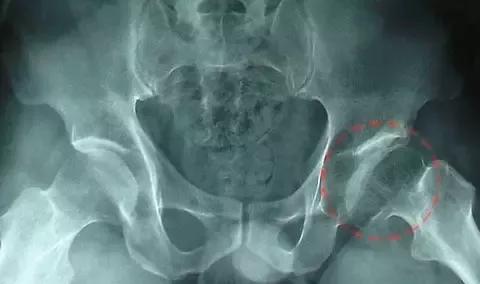 【干货】股骨头坏死的x,ct,mri的影像诊断!