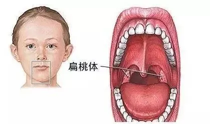 嗓子发炎肿痛怎么办（嗓子发炎肿痛怎么办吃什么消炎药）-85模板网