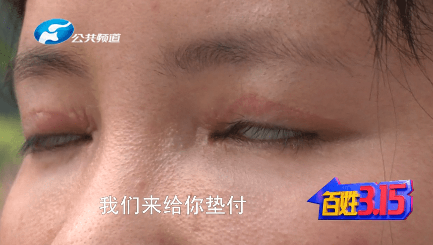 郑州凤凰医疗美容：做了双眼皮修复，眼睛闭不上