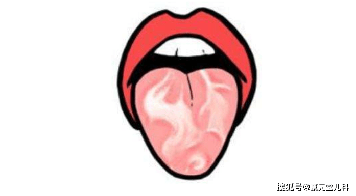 不同位置,并可变换大小和形状,具有游走性的特点,所以又称游走性舌炎