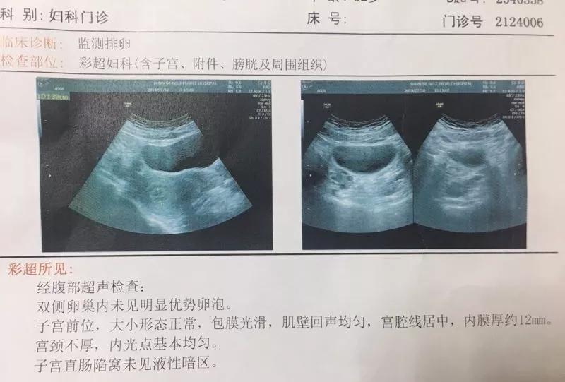 如何通过排卵试纸加b超快速怀孕?看看医生怎么说!