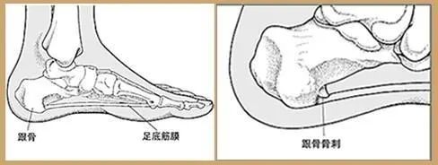 南阳医专第一附属医院骨科一病区足跟骨刺听听骨科医生怎么说