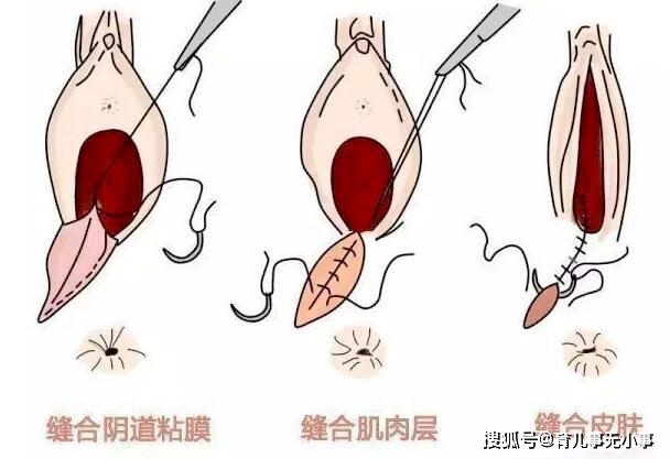 剖腹产和顺产,哪个更痛?听听妈妈们的生产过程