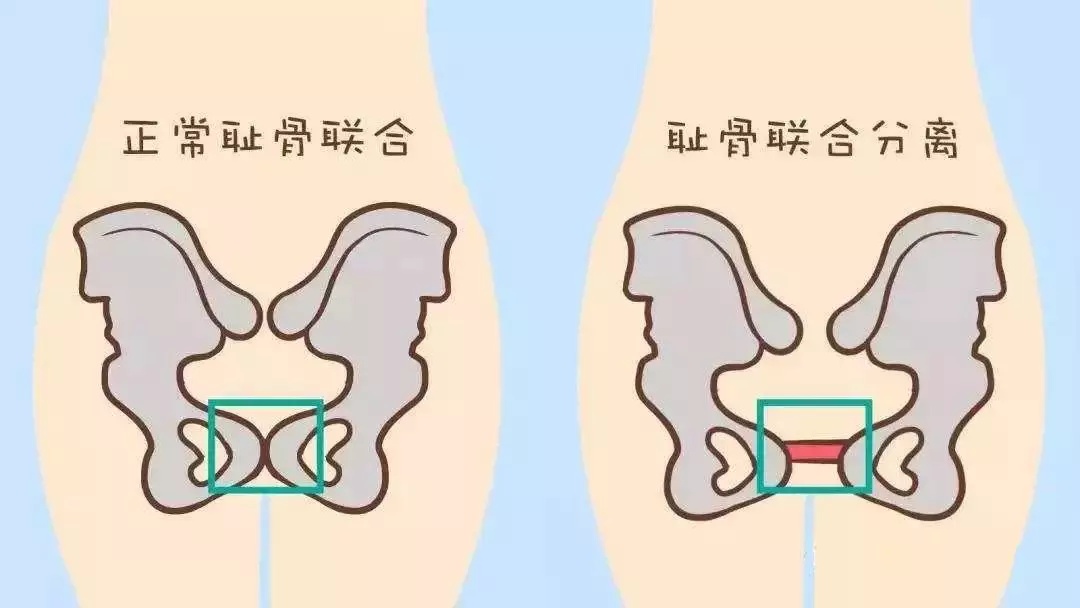 俏管家家政,耻骨联合分离知多少_骨盆