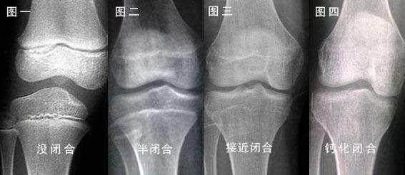 身高|是长得晚还是天生矮？尽早发现也许能挽回几厘米孩子迟迟没长高