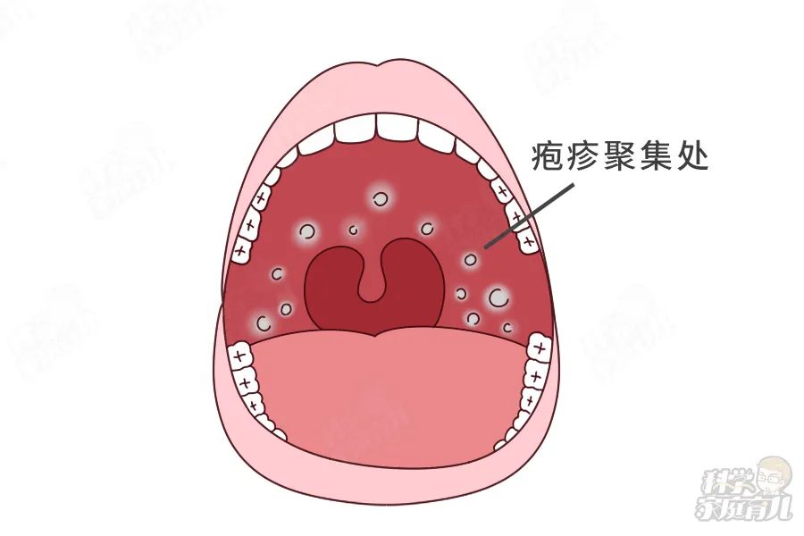 原创强传染!正高发!娃发烧后有这个症状,千万当心!