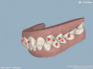 做牙齿矫正需要拔牙的情况,一般是拔前磨牙.