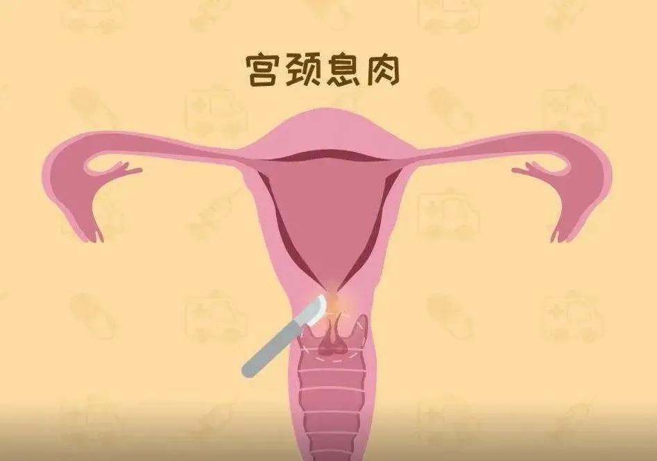 宫颈炎放置不理,会癌变吗?
