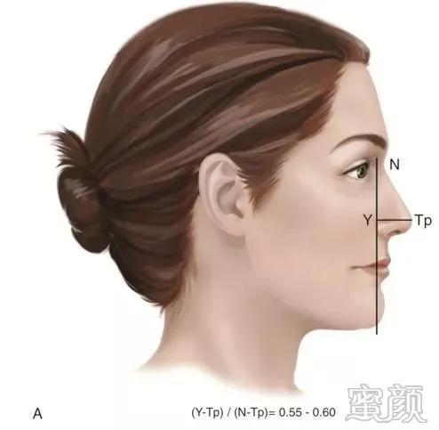 侧面观鼻尖与周围结构比例合适,具有恰当的鼻尖突出度,鼻唇角在90-110