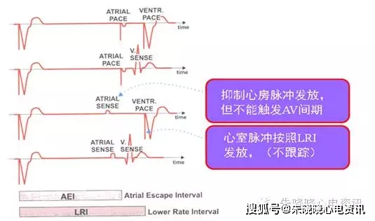 心脏起搏心电图-概念与基础