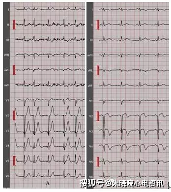 超急性t波的心电图特征与鉴别诊断