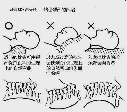 有一种颈椎病严重时可导致瘫痪,警惕乱按摩和转脖子