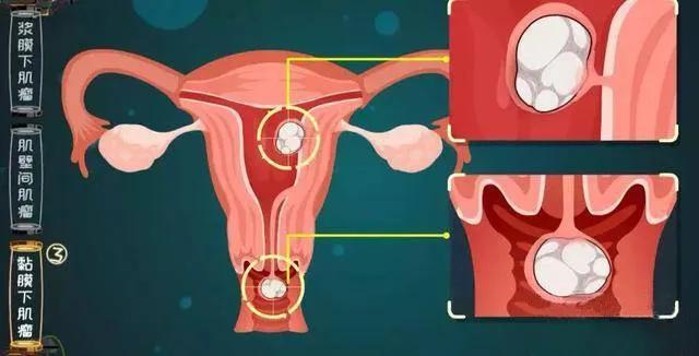 北联生物干细胞治疗子宫内膜肌瘤,维护女性健康