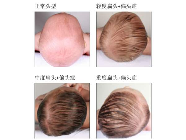 宝宝|宝宝偏头怎么矫正？看完豁然开朗