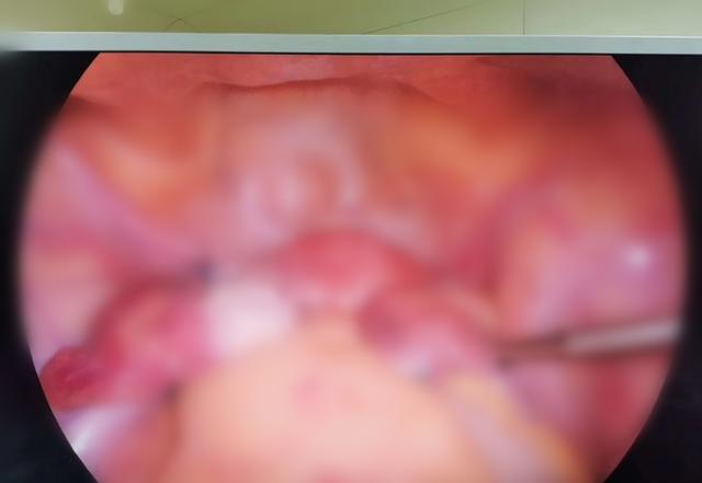 太原中心医院妇科个体化手术方案、娴熟腹腔镜术解决患者难言之痛