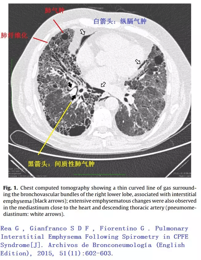 经典图谱 实战图谱,一文看懂肺气肿!
