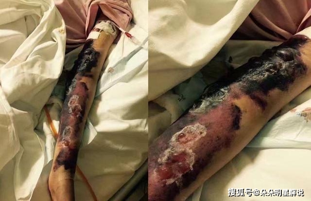 艺人徐婷,被家人吸血十几年,26岁患癌身体溃烂而死