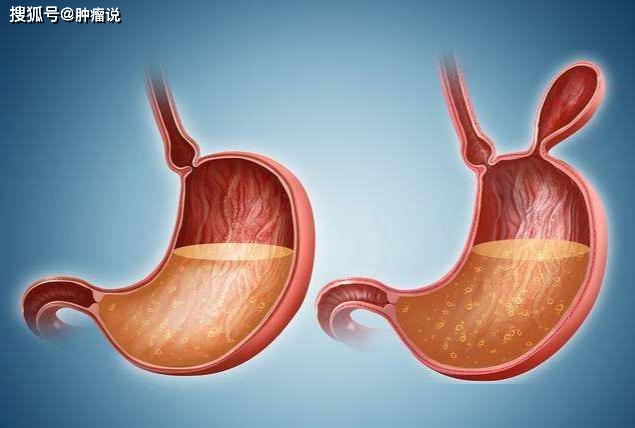 01 四步:从胃炎到胃癌 correa序列提出:从胃炎到胃癌有四步演变过程.