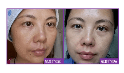 这样做改善面部暗沉美白淡化斑点