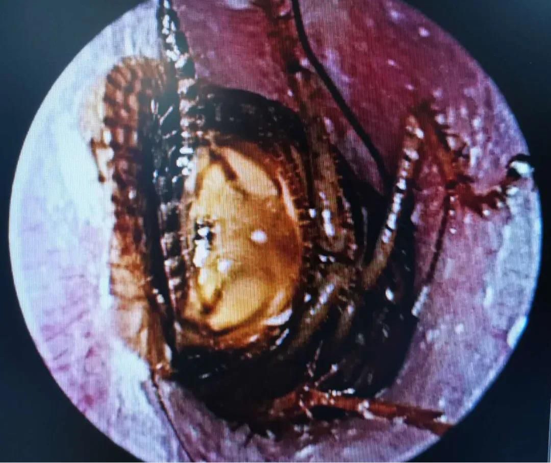 汕头市中心医院接诊了一位特殊的外耳道异物患者:蟑螂卡在耳朵里!