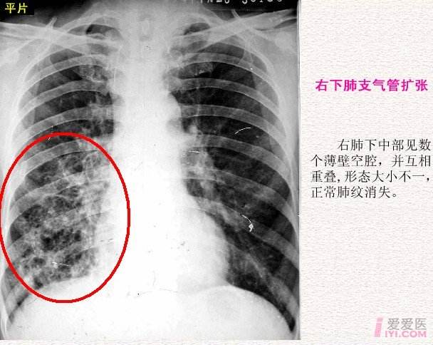 支气管扩张虽然是一种发生于气管的慢性疾病,但是此病比气管炎更加