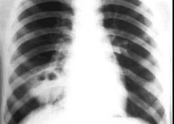 先天性支气管囊肿,支扩,肺脓肿的影像学鉴别