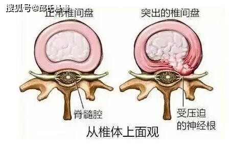 邱氏悬壶:如何避免得上腰间盘突出?腰间盘突出需要注意哪些问题?