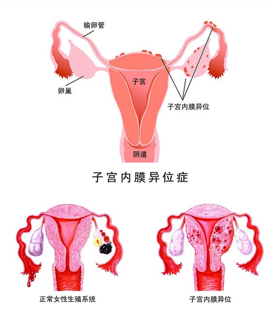 子宫腺肌症是什么意思啊 41df0d33a3a4483093d445afbe6b6bb7.jpeg