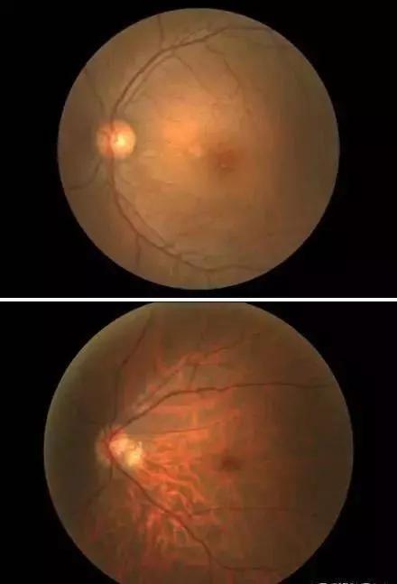 近视人群常见的眼底豹纹状改变