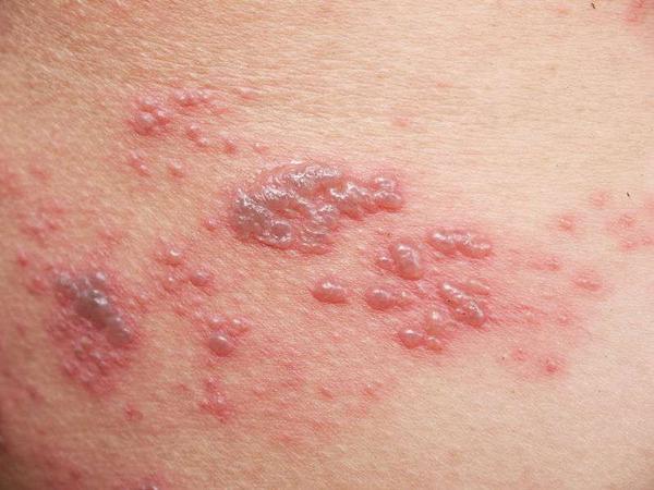 带状疱疹也叫缠腰蛇,是人被一种"水痘-带状疱疹"病毒感染后出现的