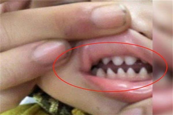 可是后来才发现孩子的牙齿居然越来越长得像鲨鱼牙,这让刘女士很是