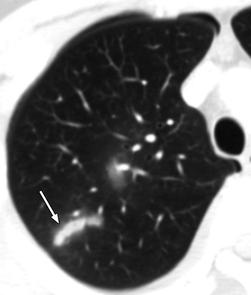 a,软组织(左)和肺窗(右)ct显示,胸膜增厚延伸至肺结节(箭头).