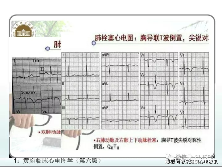 非心脏病的心电图异常